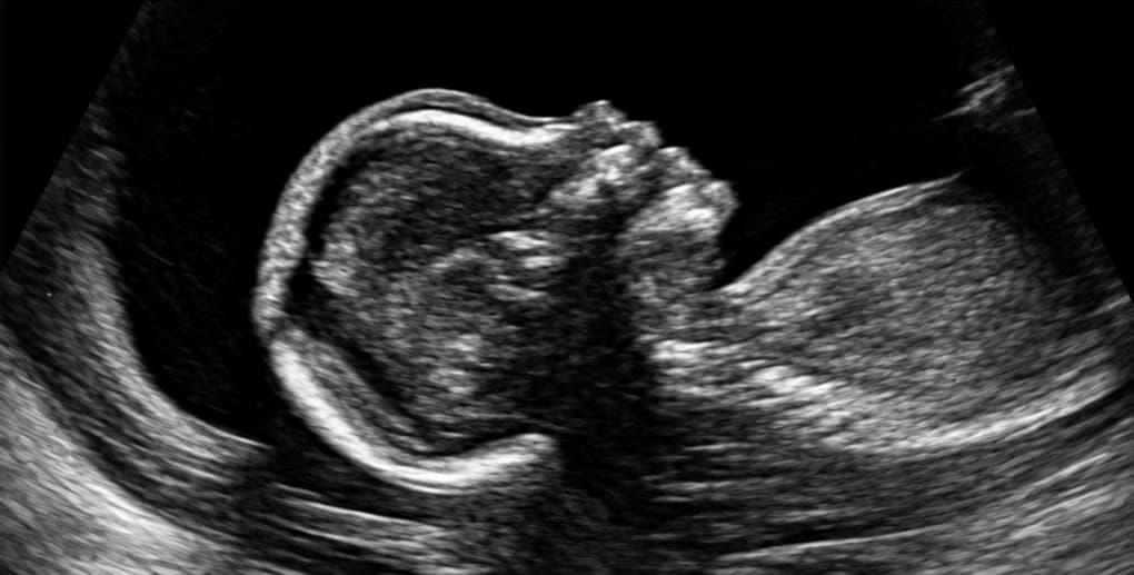 An ultrasound photograph of Mercer, seen in profile.